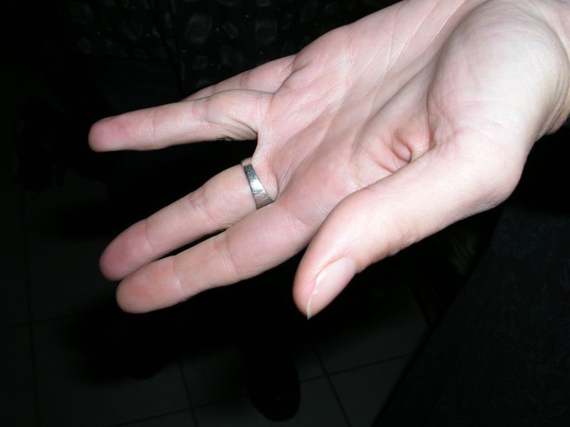 The injured finger. You can just barely see the scar